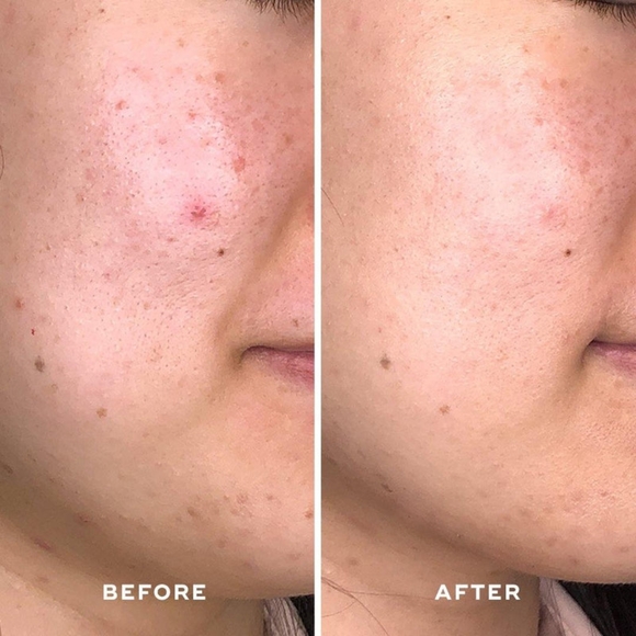 🆕️Aceology Detoxifying Treatment Mask | Detoxifies, Purifies, & Regenerates - Picture 4 of 13